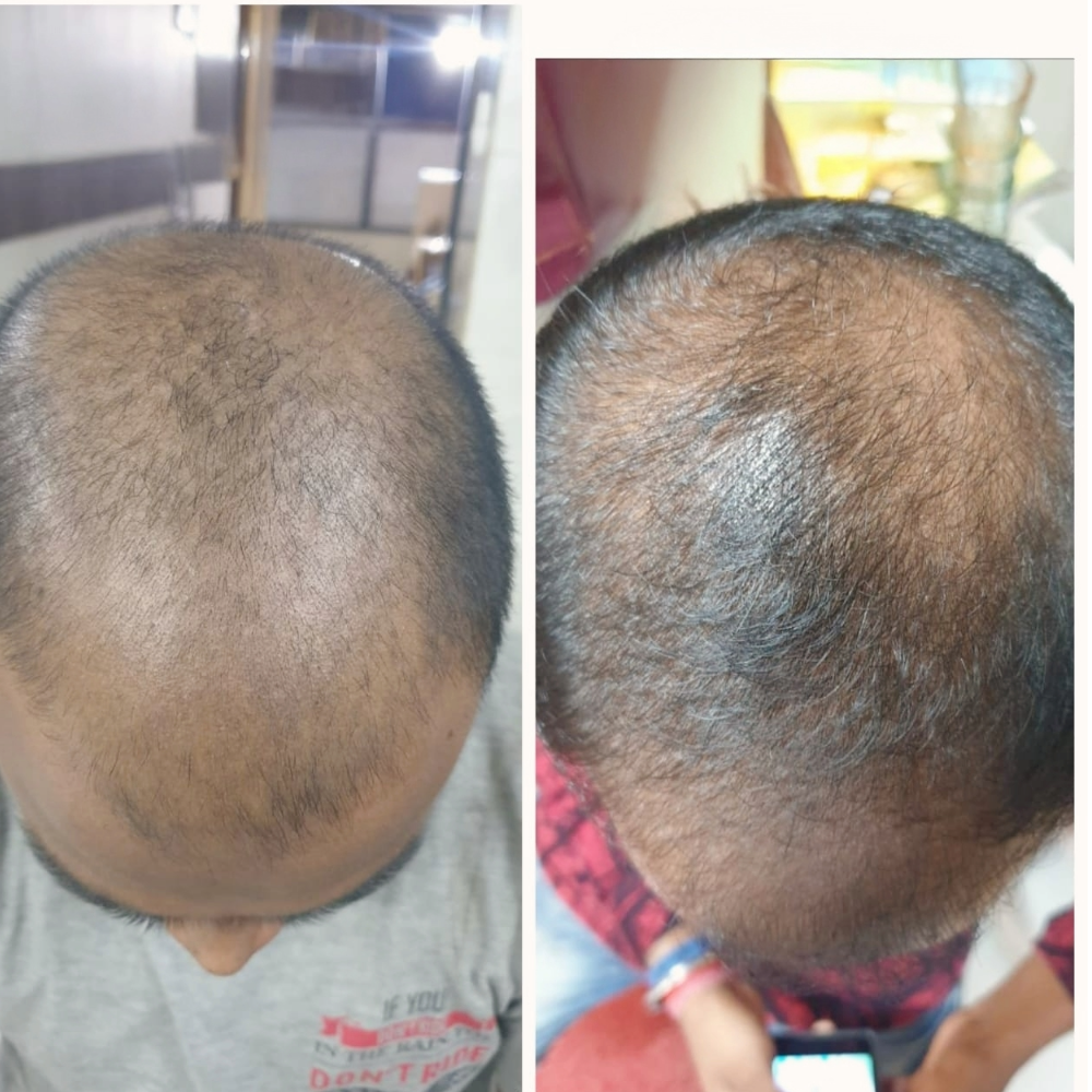 Visible regrowth with consistent use